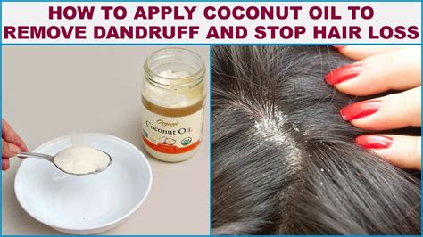 How to Use Coconut Oil For Dandruff - 3 Effective Ways to Fight ...