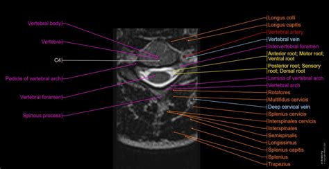 Cervical Spine Mri Labeled