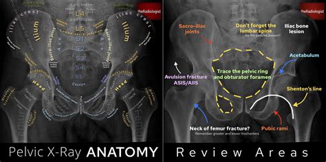 Normal hip joint anatomy xray - westsilicon