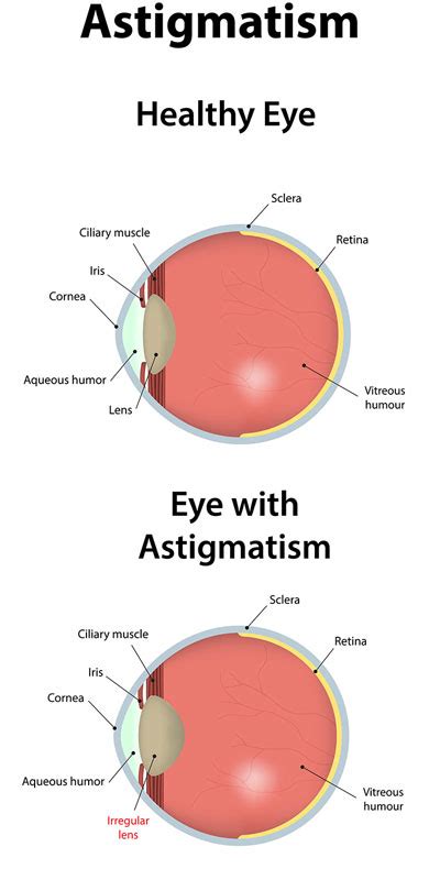 Astigmatism causes Blurred Vision - First Eye Care Downtown Dallas