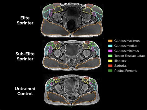 Mri Plantar Foot Anatomy Muscles