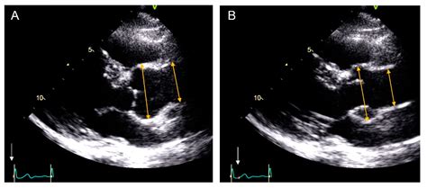 Are Aortic Root and Ascending Aorta Diameters Measured by the Pediatric ...