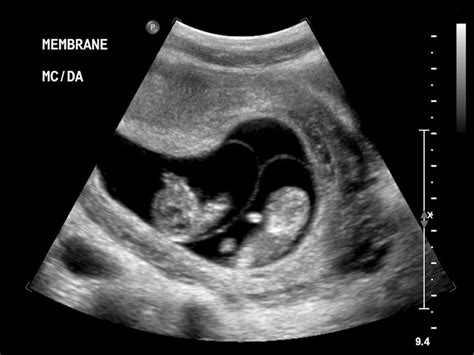 Monochorionic Diamniotic Twins Ultrasound