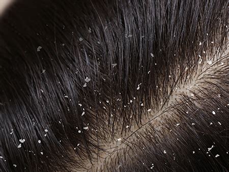 Dandruff - Causes, Symptoms and treatments