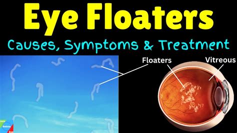 What are Eye Floaters? - Causes, Symptoms, Treatment & Prevention - YouTube