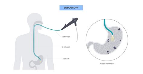 Premium Vector | Gastroscopy procedure Gastroenterologist uses a ...