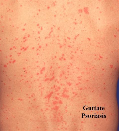 The Best Guttate Psoriasis Treatment Options & 7 Tips to Prevent ...