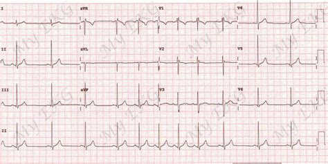 Sinus Arrhythmia