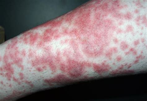 Diabetic skin rash pictures | Symptoms and pictures