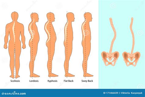 Thoracic Kyphosis Black Glyph Icon Cartoon Vector | CartoonDealer.com ...