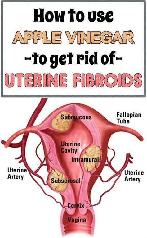 Pin on Fibroids treatment