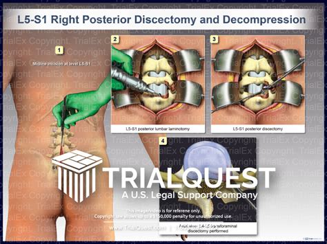 Microdiscectomy Scar