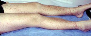 IgA Vasculitis (Formerly Henoch-Schönlein Purpura or HSP) | UNC Kidney ...