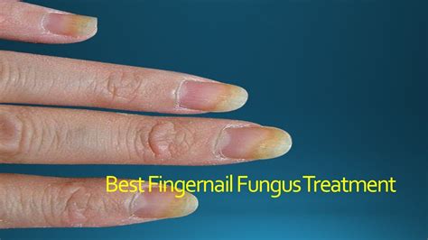 Best Fingernail Fungus Treatment - YouTube