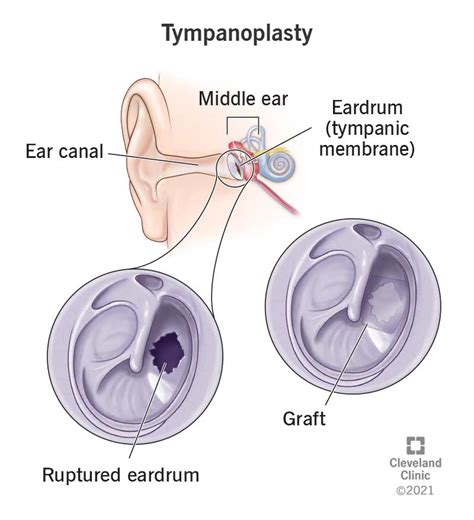 Ruptured Eardrum Tympanic Membrane Perforations, 46% OFF