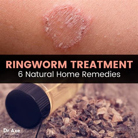 Ringworm Treatment: Try These 6 Natural Remedies - Dr. Axe