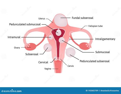 Submucosal Fibroids. Endometriosis. Infographics. Vector Illustration ...