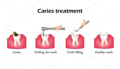 Tratamiento de la caries. Perforando un diente. Sellado del diente ...