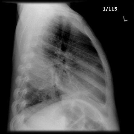 Lateral Chest Xray