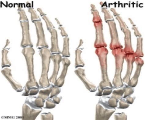 Arthritis of the MCP joint: Orthopedic Center for Sports Medicine ...