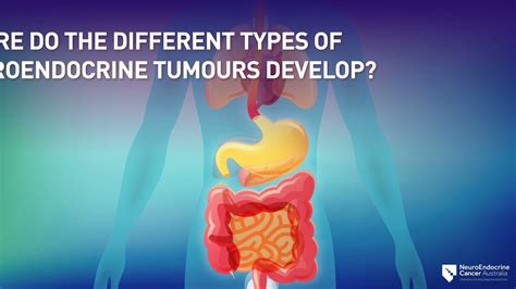 Symptoms Types and Diagnosis of Neuroendocrine Tumours (NETs) - YouTube