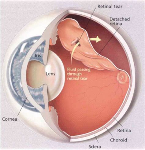 Treatment of Retinal Detachment | Review of Retinal Detachment