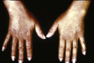 Scleroderma (Systemic Sclerosis): Treatment of the Hand ...