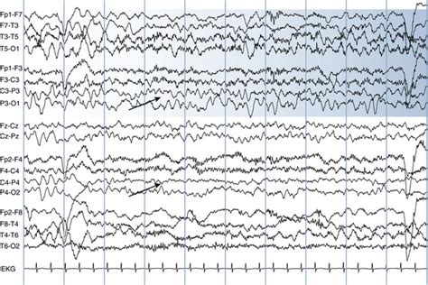 The Abnormal EEG | Neupsy Key