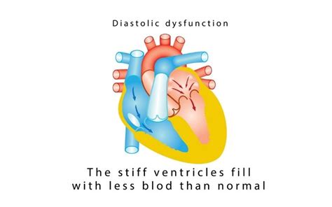 Congestive Heart Failure Overview: Causes, Symptoms and Treatment