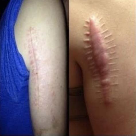 Skin Cancer Scars Images | SkinCancer.net