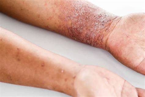 Atopic dermatitis causes, symptoms, diagnosis, treatment & prognosis