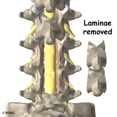 Lumbar Laminectomy | eOrthopod.com