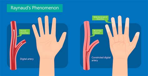 Raynaud Disease | The Surgical Clinic