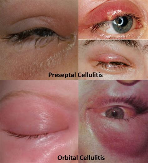 Swollen Eyelid - Know the causes, remedies and alert signs