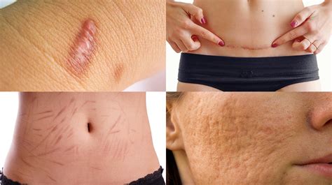 Scar Removal in Niddrie | Laser Scar Treatment | O’Laze