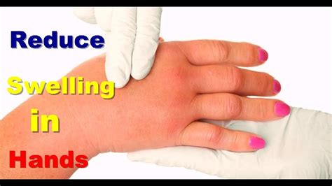 First Class Info About How To Reduce Swelling In Hands - Sumresort14