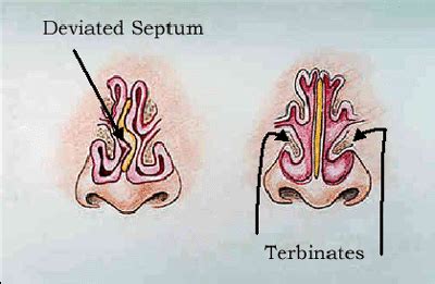 Deviated Septum Surgery Recovery | New Health Advisor