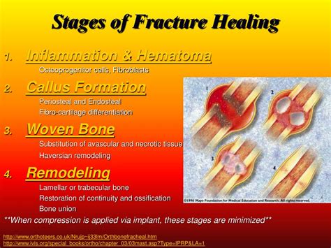 Bone Fracture Healing Stages