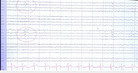 Abnormal EEG due to focal slowing and occasional spike and wave ...