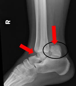 Talus Fracture | Orthopaedic Trauma Association (OTA)