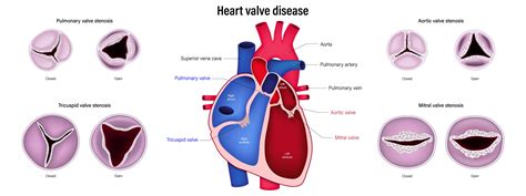 Heart Valve Replacement - Understanding Heart Valve Diseases and ...