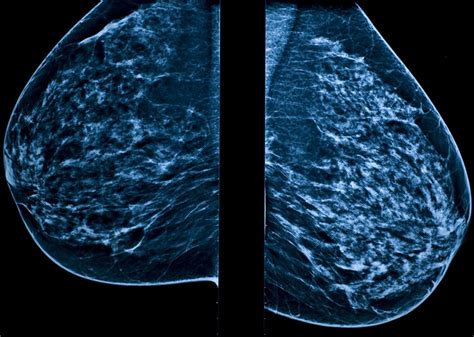 Is a 3D Mammogram Right for Me? | Community Health Network