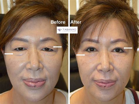 Korean Plastic Surgery Before And After Eyes