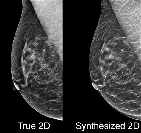 Mammography: March 2016