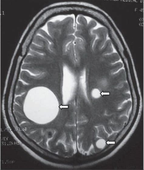 Cyst on gumline