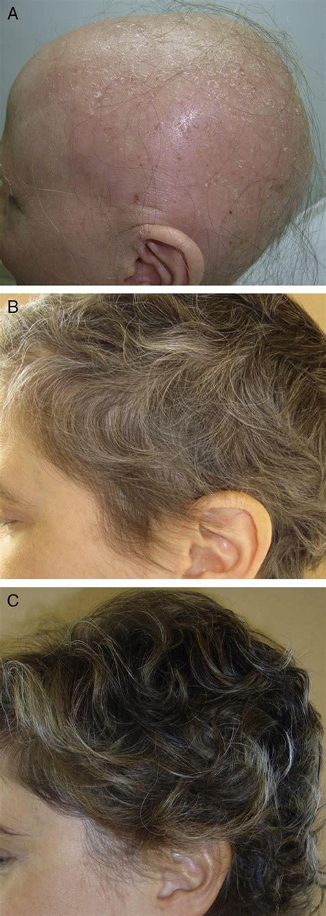 A 34-year-old woman with alopecia areata universalis. Hair regrowth ...