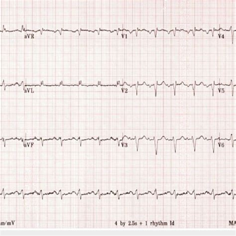 EKG showing prolonged QTC interval, left-axis deviation, and ...