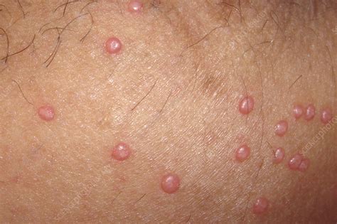 Molluscum contagiosum - Stock Image - C051/5766 - Science Photo Library