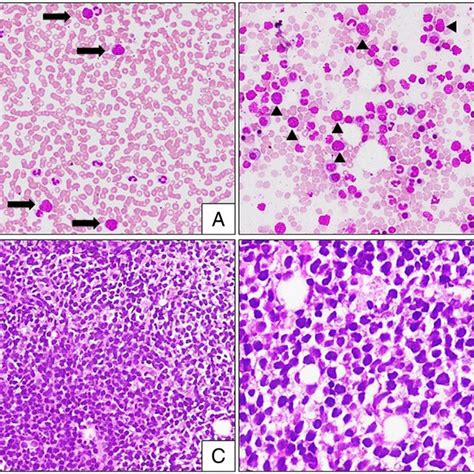 -Lymph node biopsy with IHC: (A, B) Lymph node biopsy with completely ...