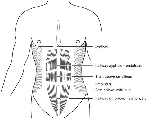 Reference points for the measurement of the linea alba width | Download ...